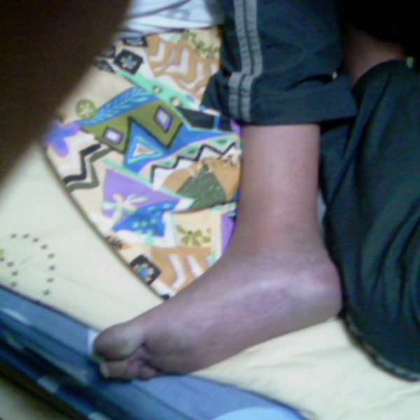 往生前的腳浮腫呈現紫色 往生前的腳浮腫呈現紫色